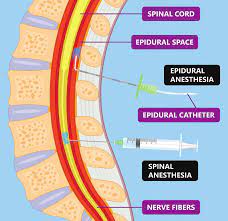 Regional anesthesia 