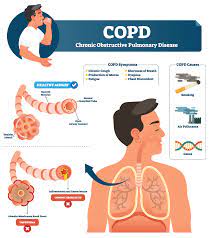  Respiratory system PCD